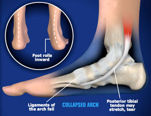 Flatfoot/Fallen Arches - Foot Associates of NY